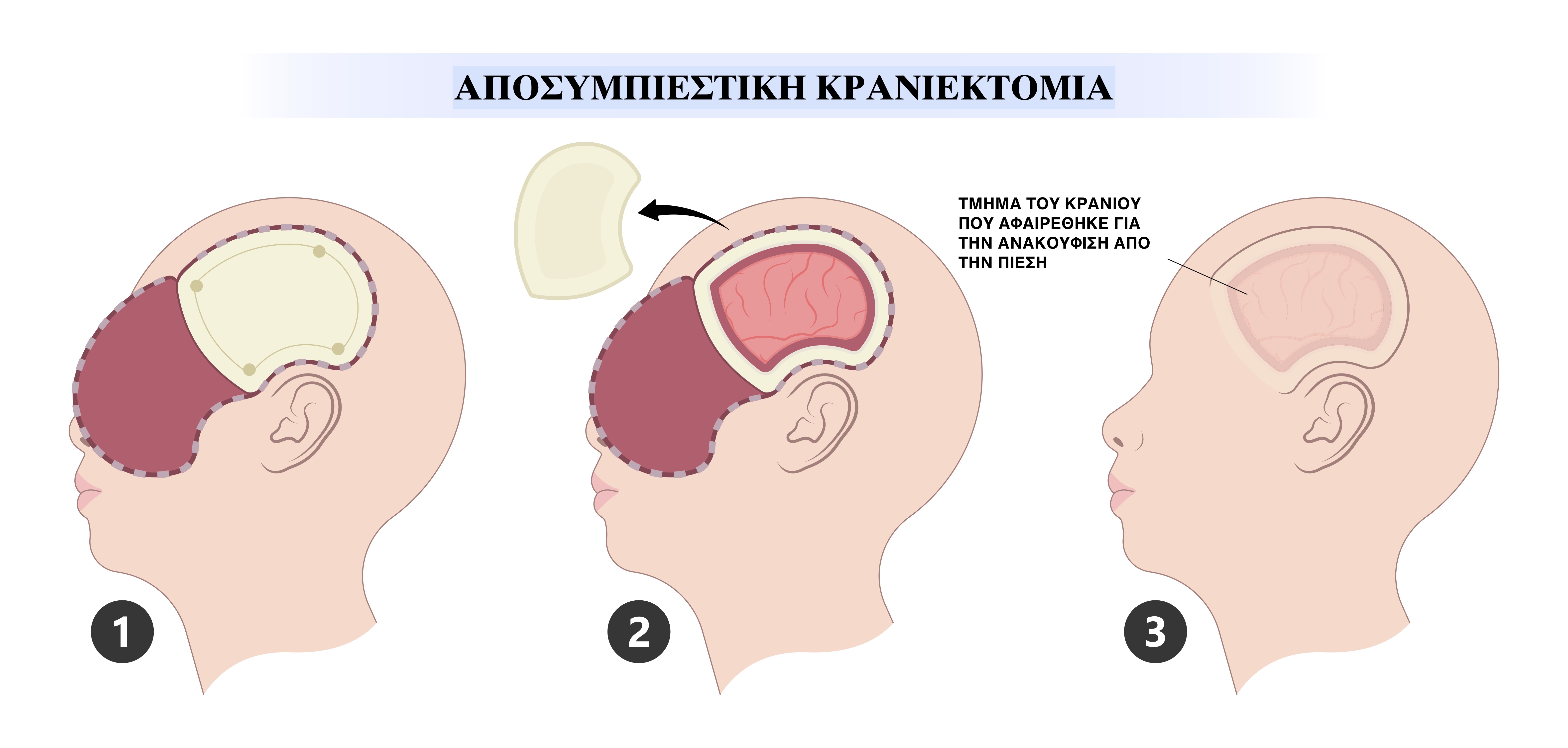 Αποσυμπιεστική κρανιεκτομία