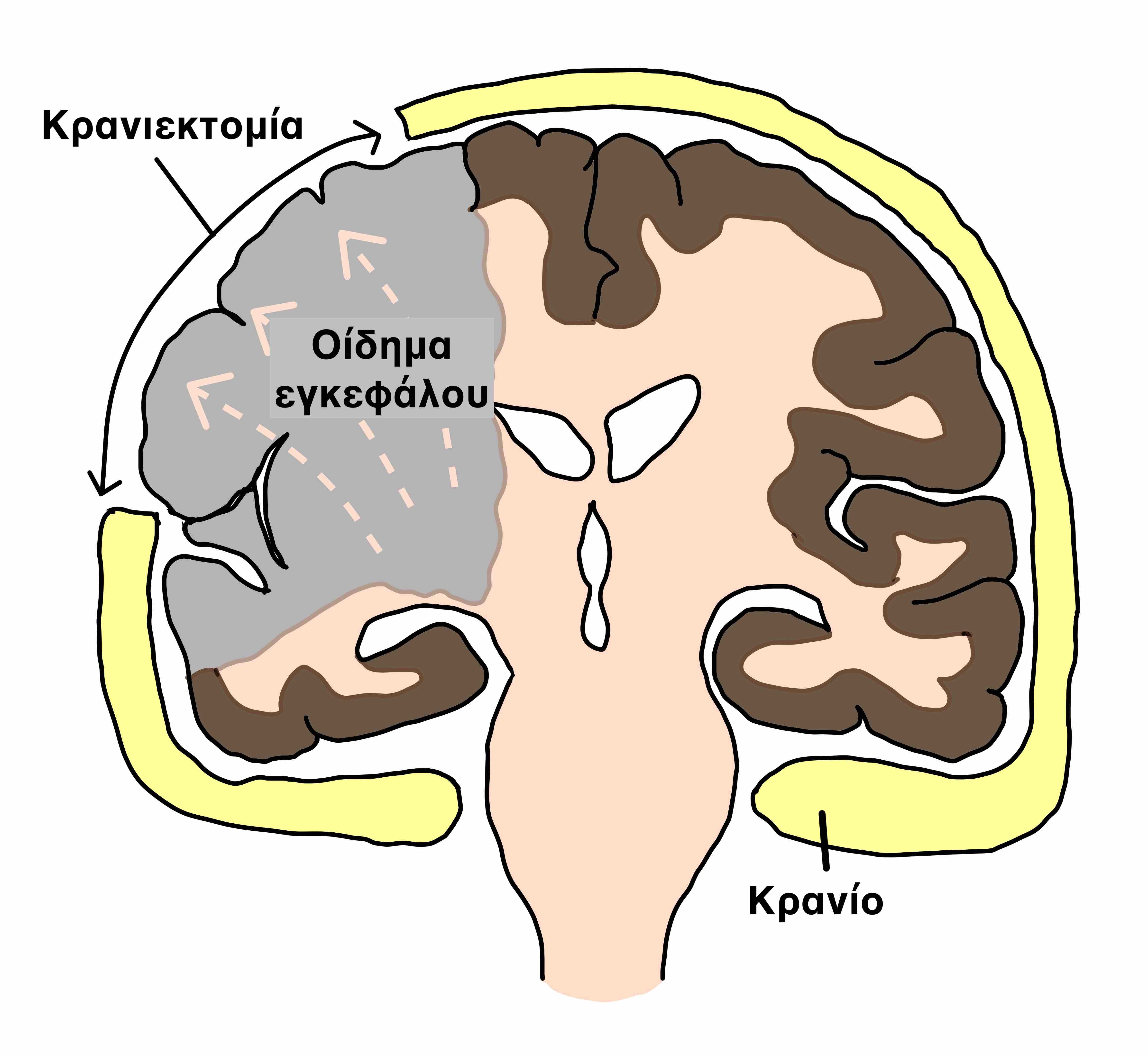 Αποσυμπιεστική κρανιεκτομία για οίδημα εγκεφάλου
