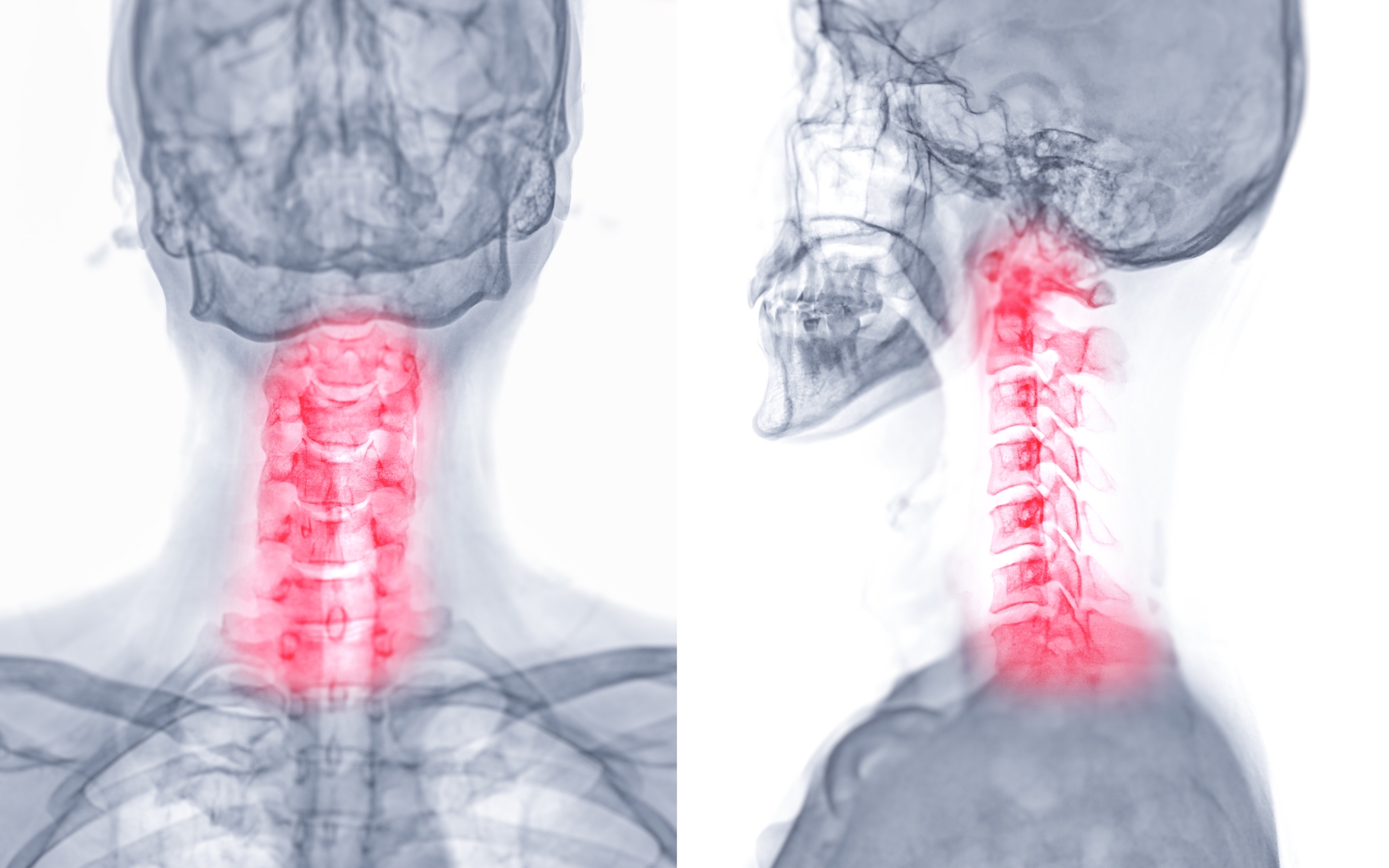 Αυχενική δισκοκήλη αυχένας x ray