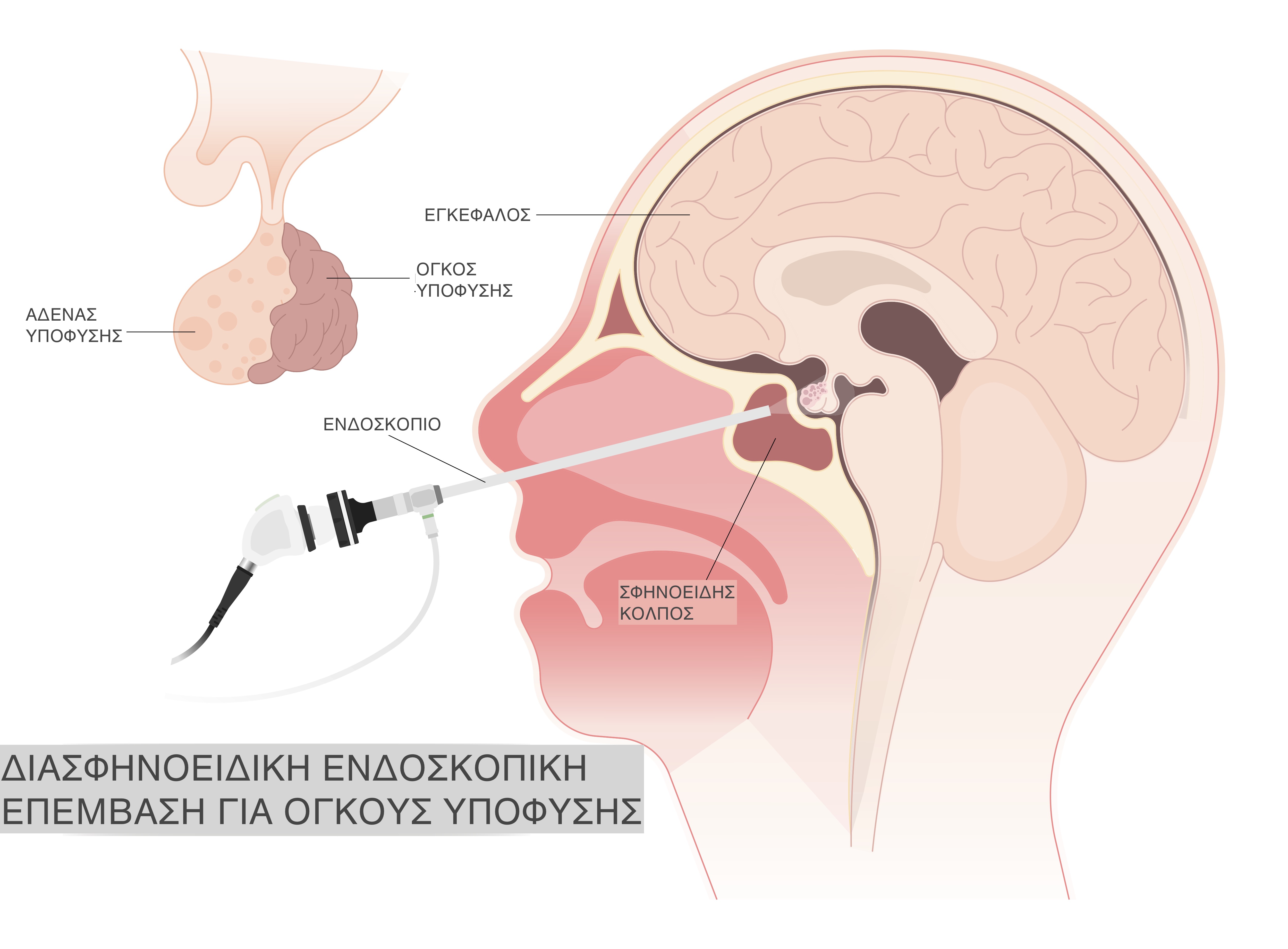 Διασφηνοειδική ενδοσκοπική προσπέλαση όγκων υπόφυσης