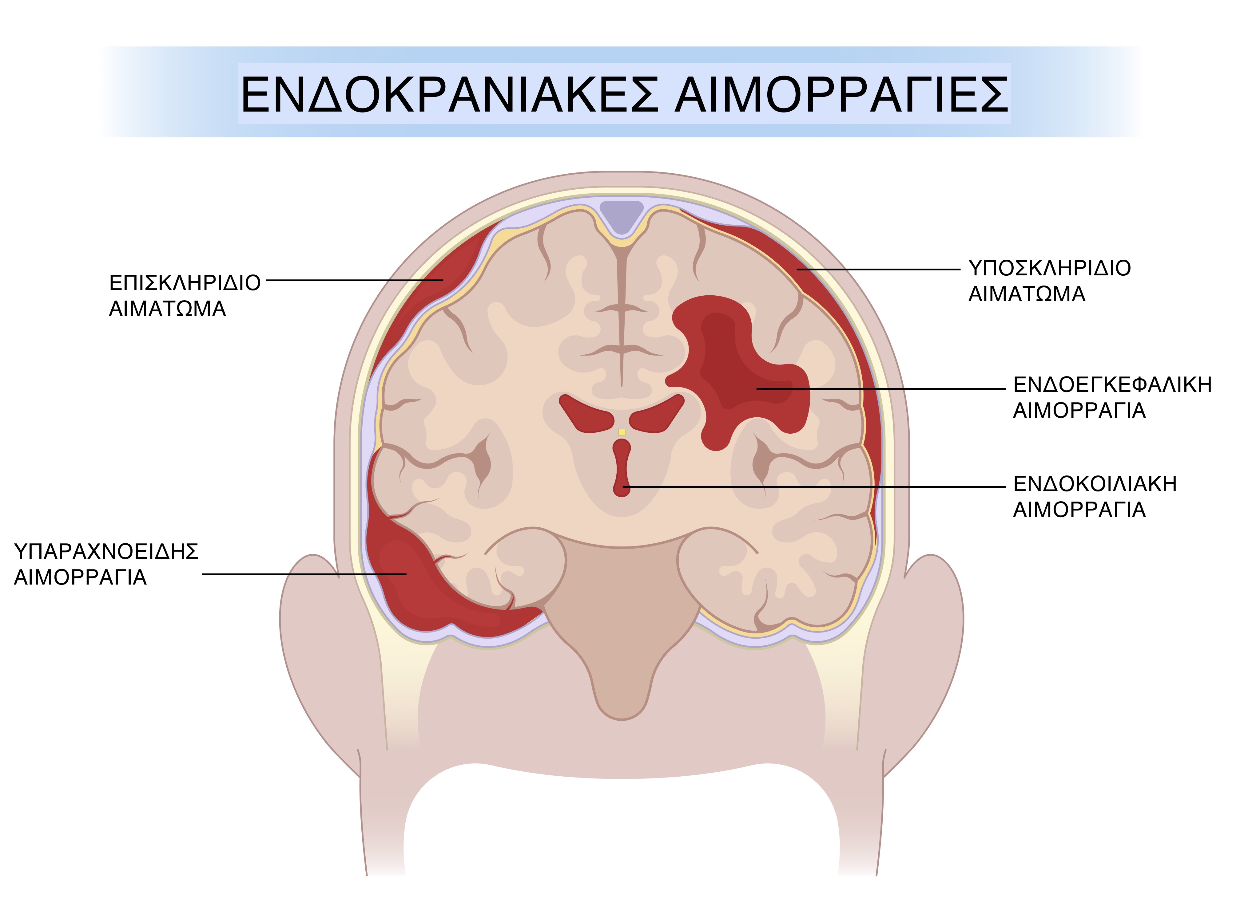 Τραυματικές ενδοκρανιακές αιμορραγίες, αιματώματα