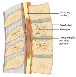 Κάταγμα σπονδύλου με τραύμα νωτιαίου μυελού