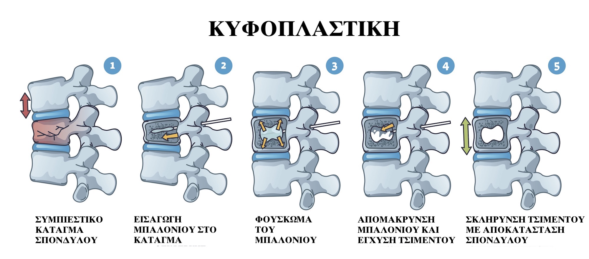 Κυφοπλαστική για κάταγμα σπονδυλικής στήλης