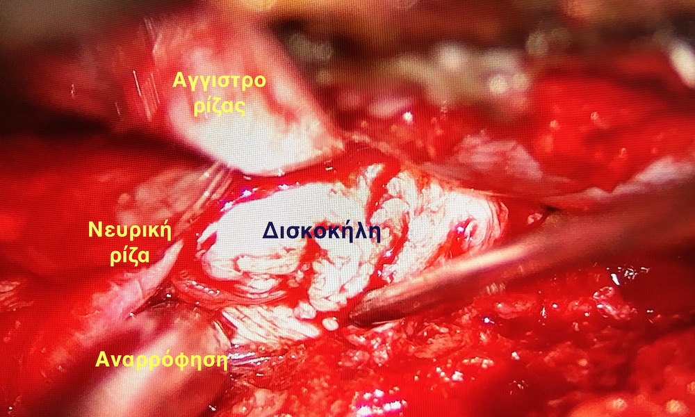 Μικροδισκεκτομή αφαίρεση δισκοκήλης