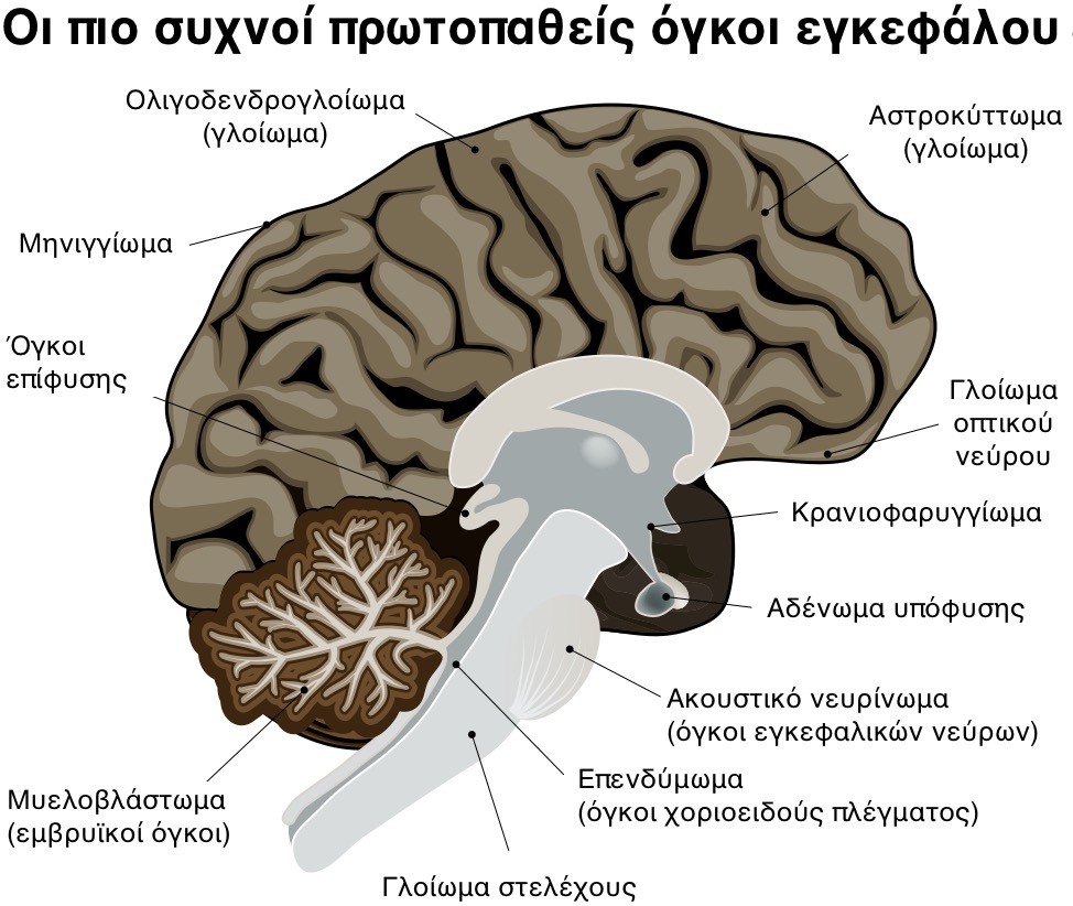 Πρωτοπαθείς όγκοι εγκεφάλου, γλοίωμα, μηνιγγίωμα