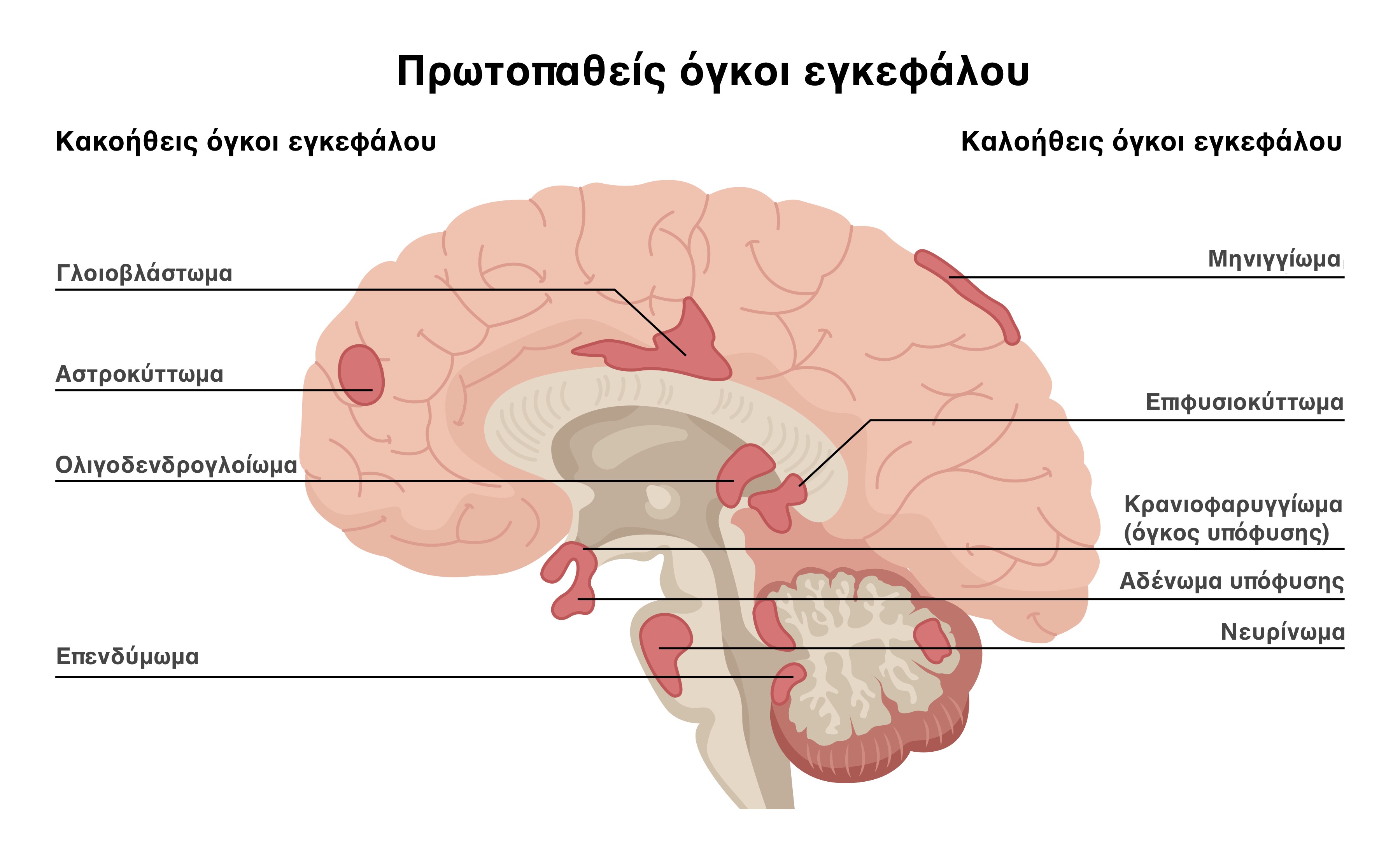 Πρωτοπαθείς όγκοι εγκεφάλου καλοήθεις και κακοήθεις