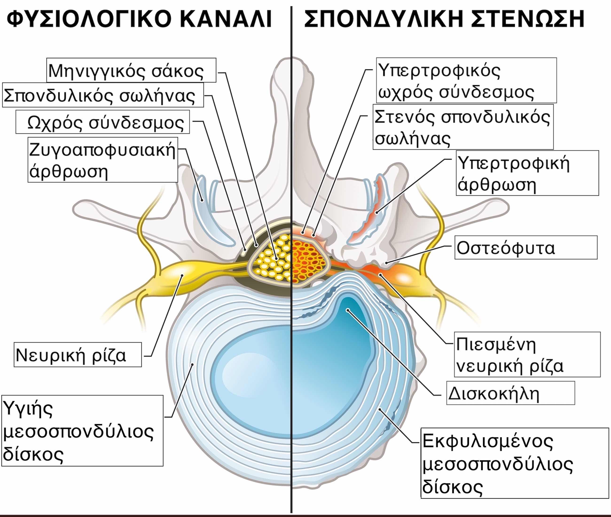 Σπονδυλική στένωση, αιτίες