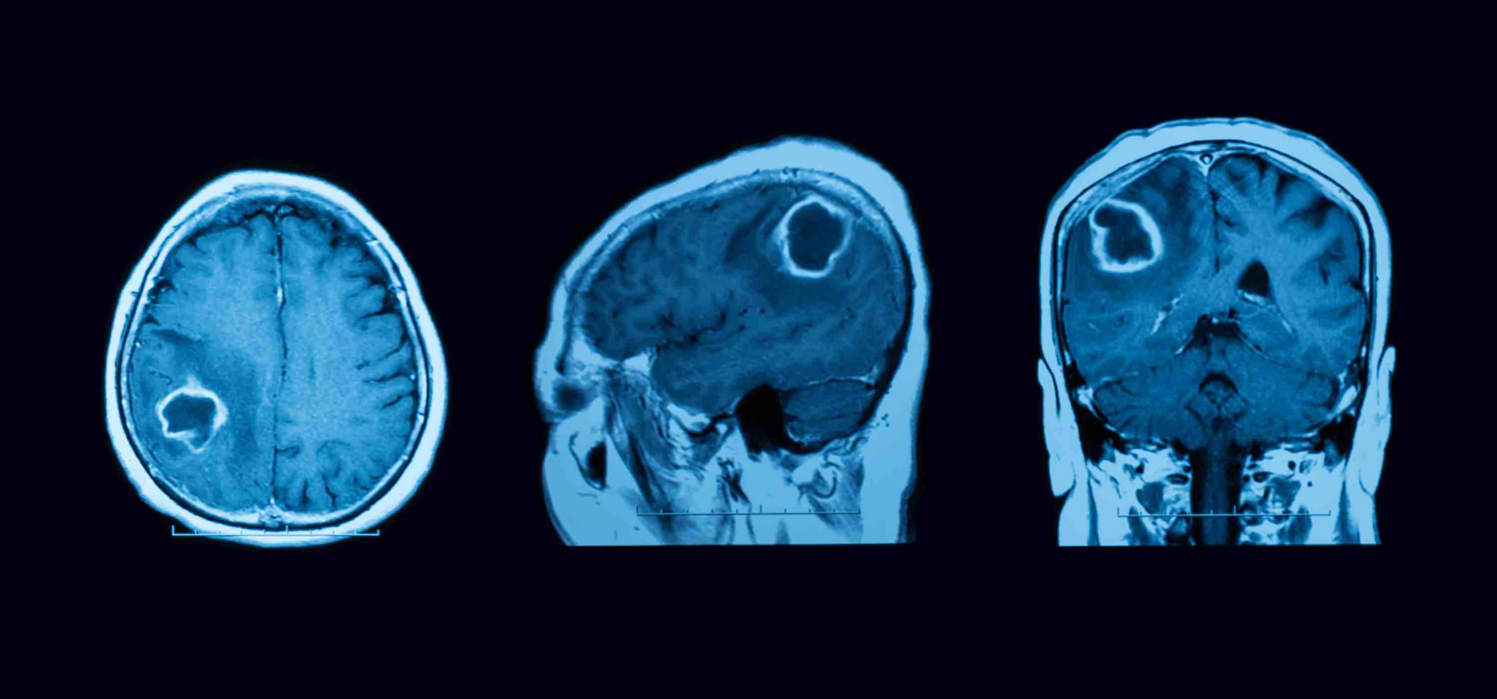 Όγκος εγκεφάλου, μαγνητική τομογραφία
