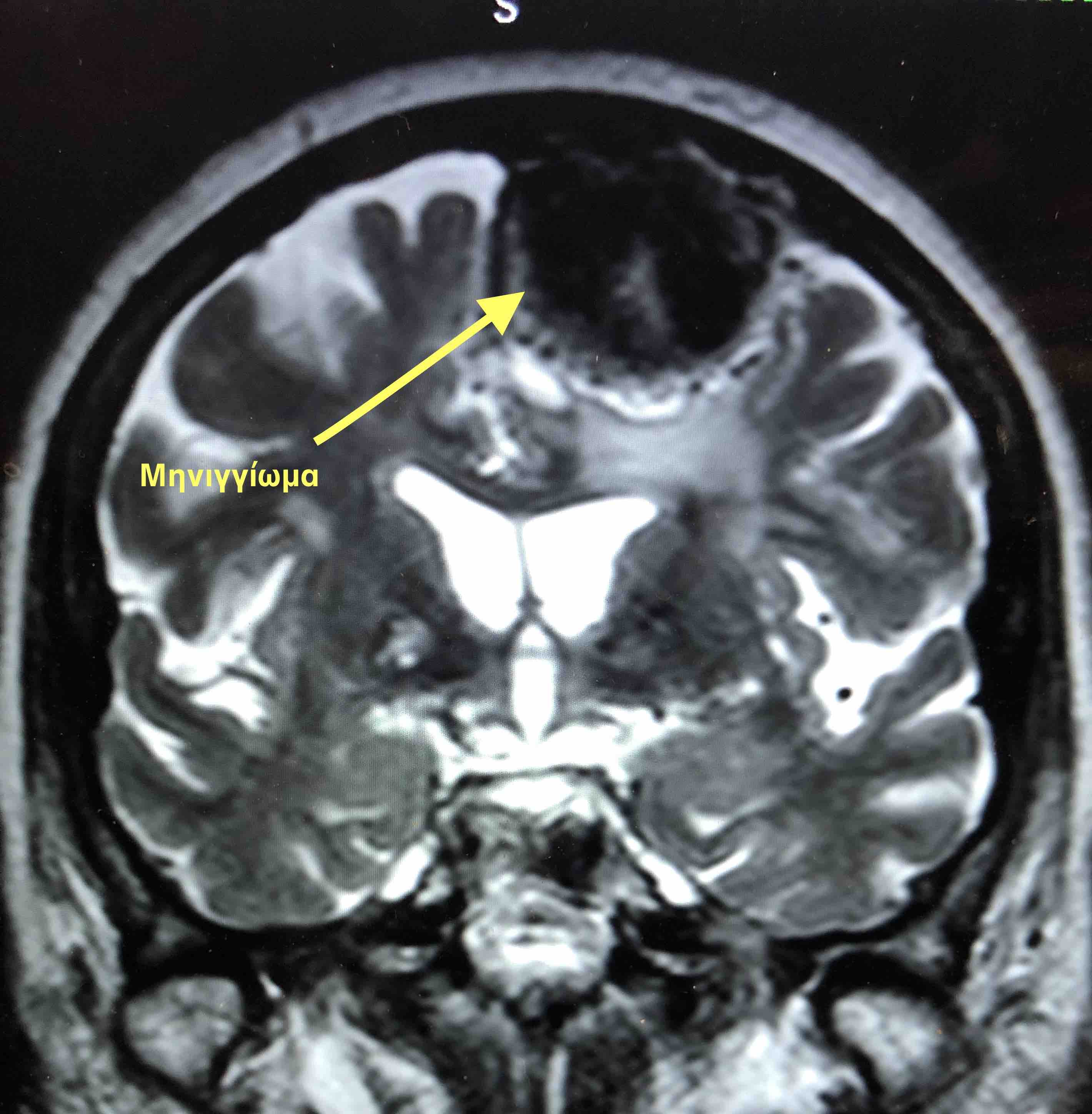 Meningioma