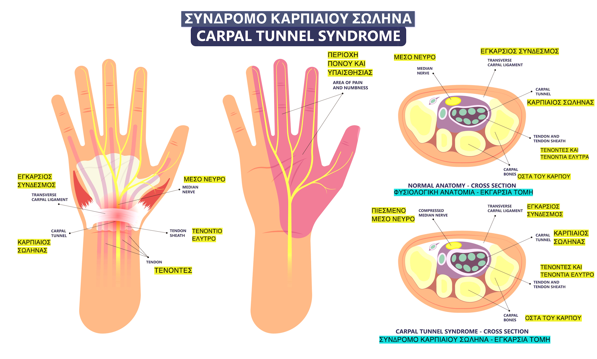 carpaltunnel