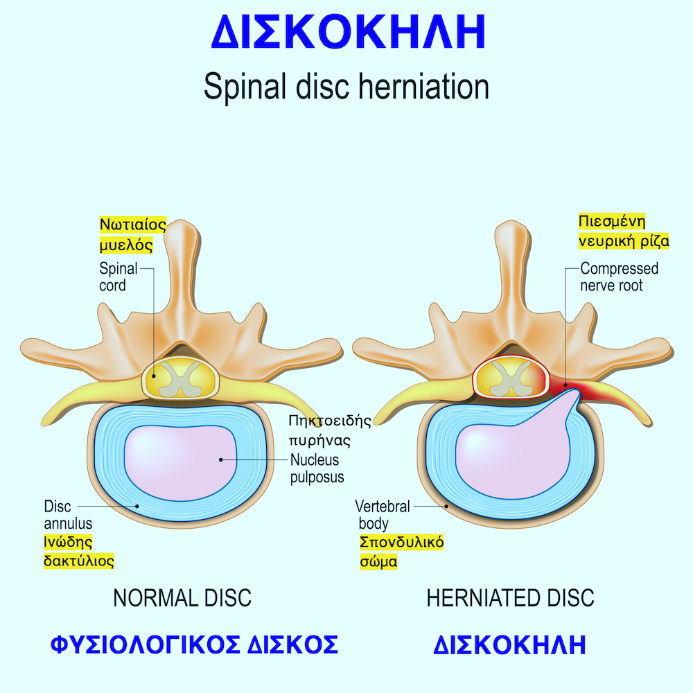 Δισκοκήλη (κήλη μεσοσπονδύλιου δίσκου) θωρακική με πίεση της νευρικής ρίζας ή του νωτιαίου μυελού