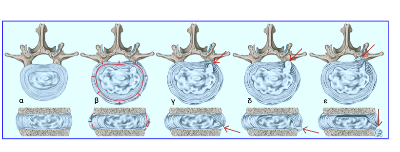 Στάδια εκφύλισης δίσκου και δημιουργία δισκοκήλης