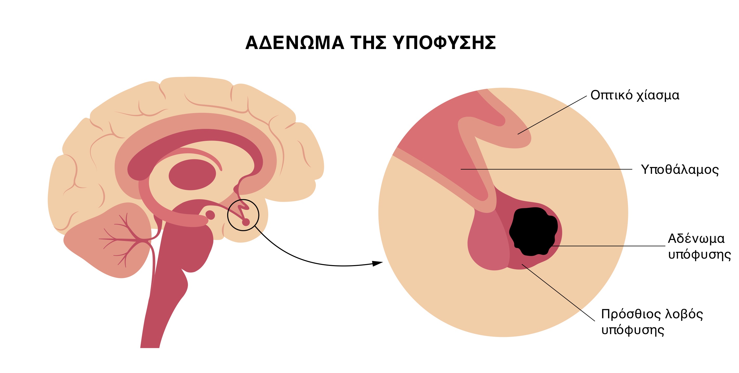 Αδένωμα υπόφυσης
